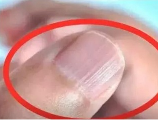 午夜成人激情视频厂家分析手指甲有竖纹的根本原因 午夜成人激情视频厂家分析手指甲有竖纹的根本原因
